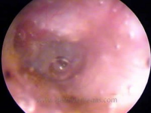 An eardrum perforation is evident by the escaping air bubble 