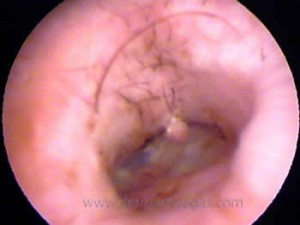Post flush, the thickened eardrum and a small polyp are revealed 