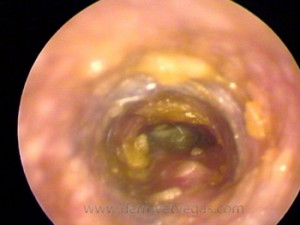An inflamed, infected ear canal prior to video-otoscopy guided flush 